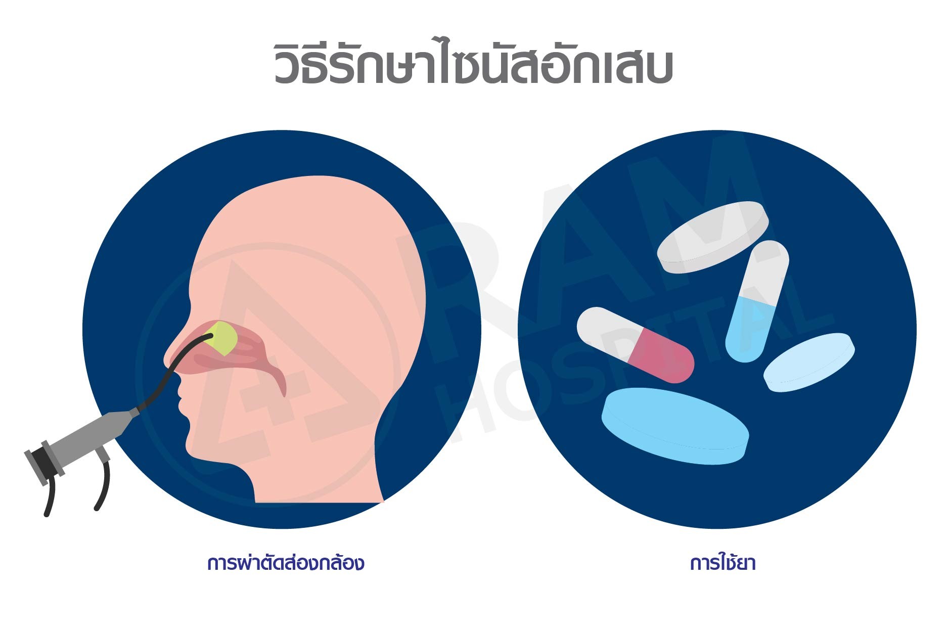 ไซนัสอักเสบ