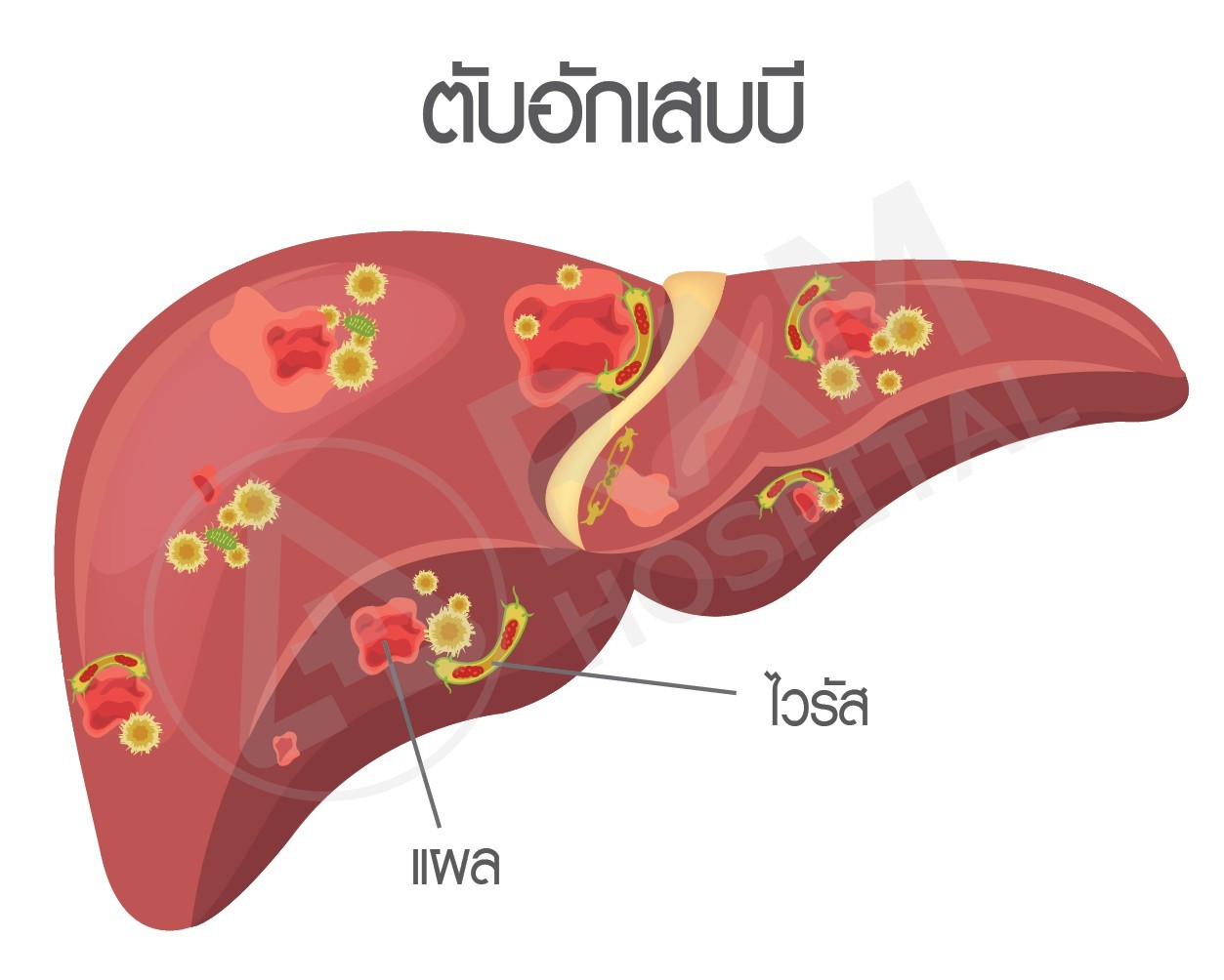 โรคไวรัสตับอักเสบบี