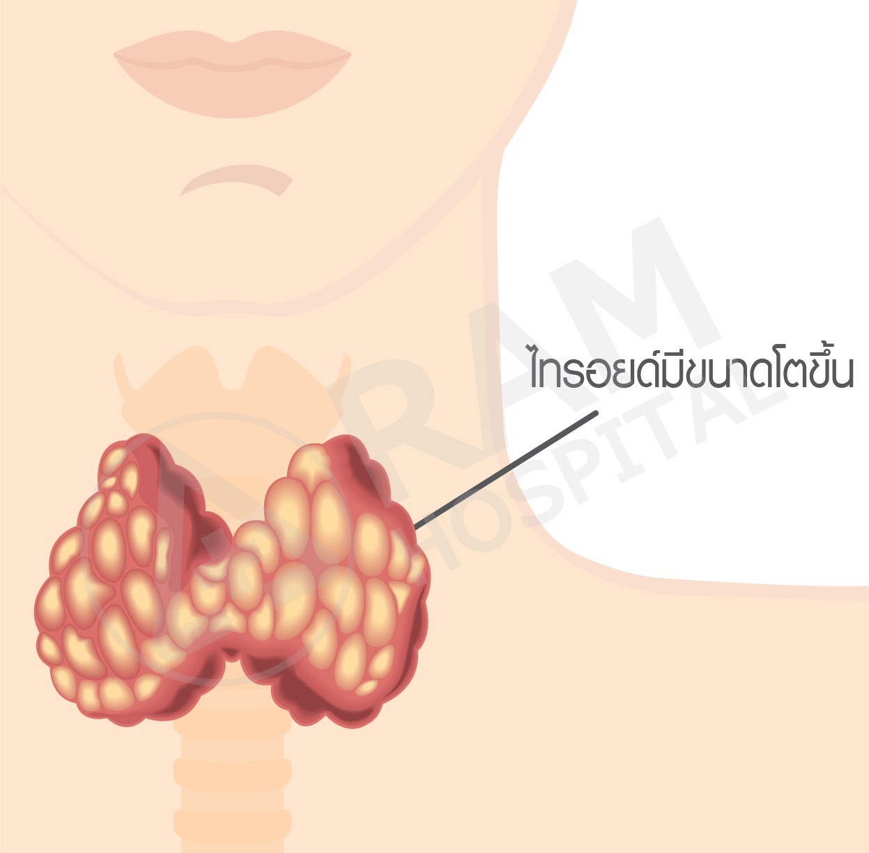 ผ่าตัดส่องกล้องไทรอยด์