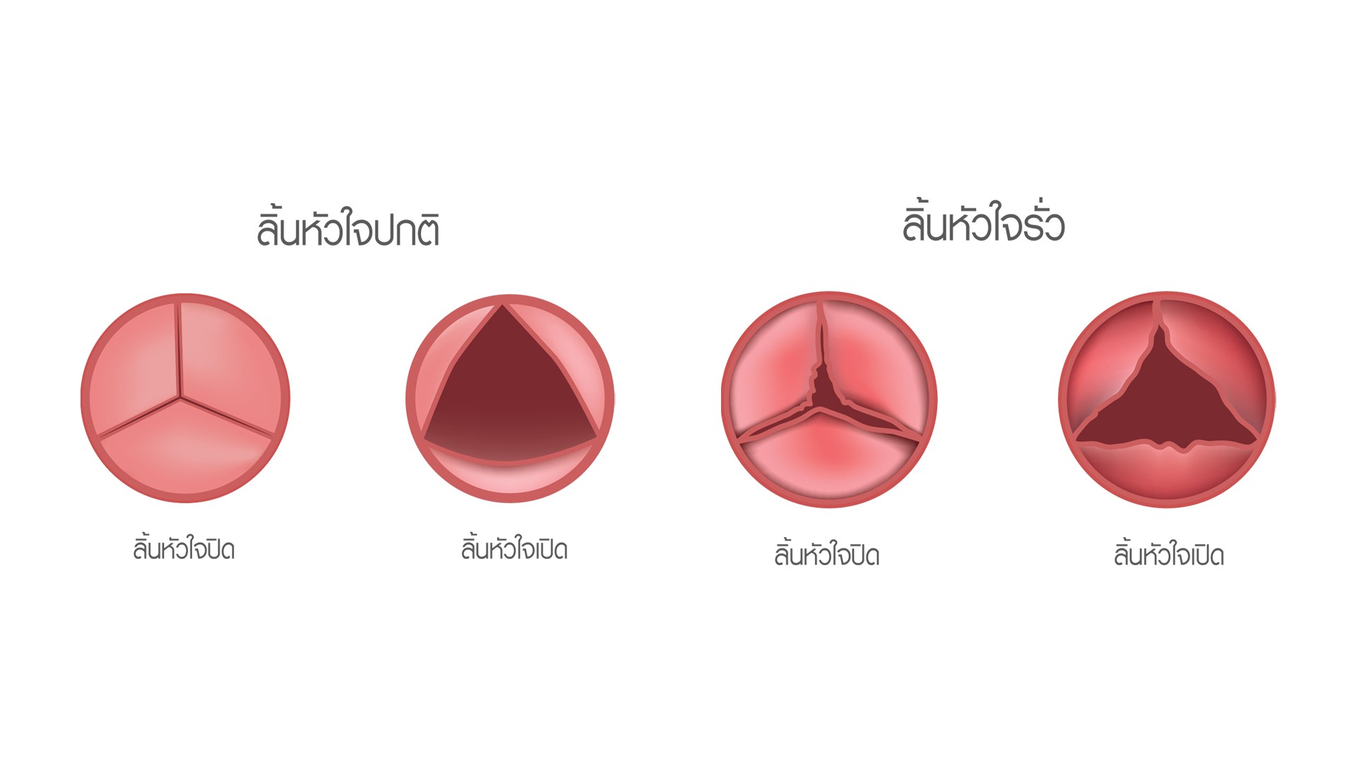 ลิ้นหัวใจตีบ รักษา ไม่ต้องผ่าตัด