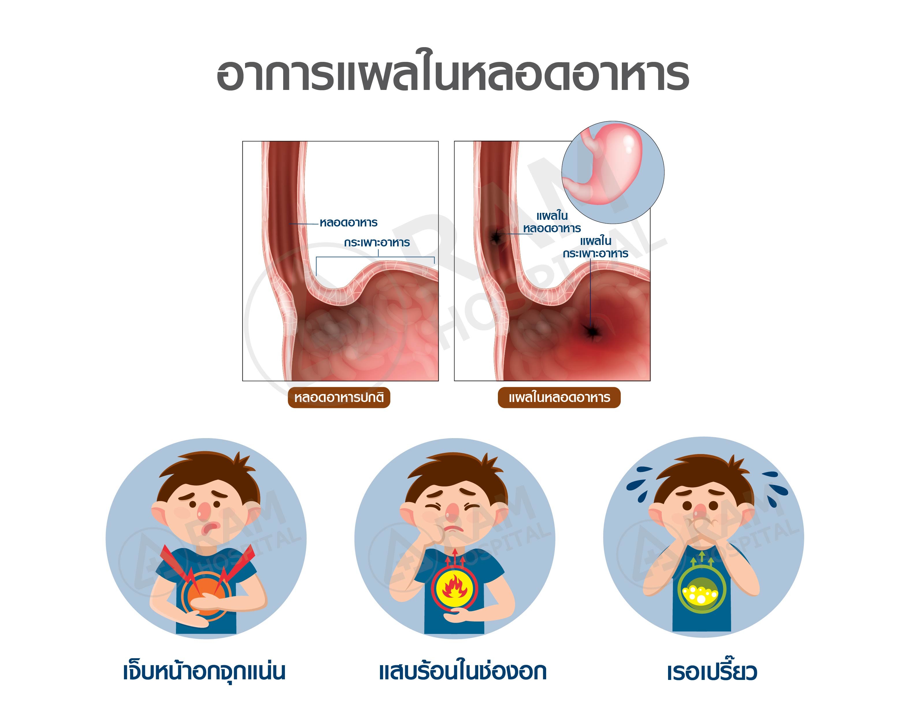 แผลในหลอดอาหาร