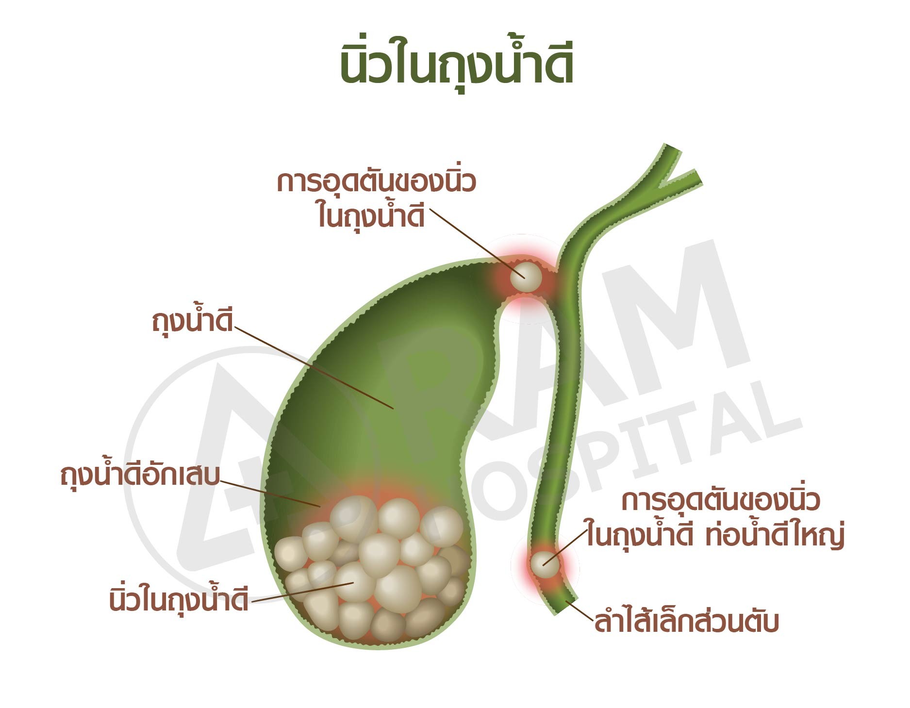 นิ่วในถุงน้ำดี