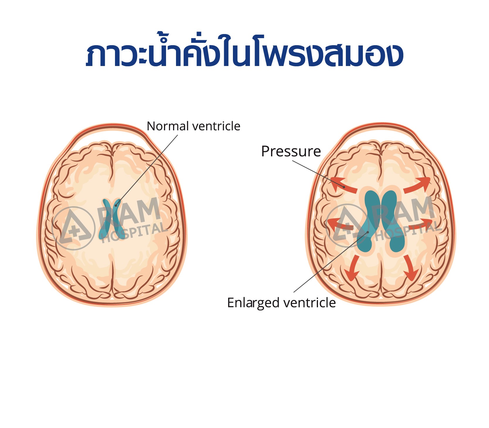 โรคน้ำคั่งในโพรงสมอง