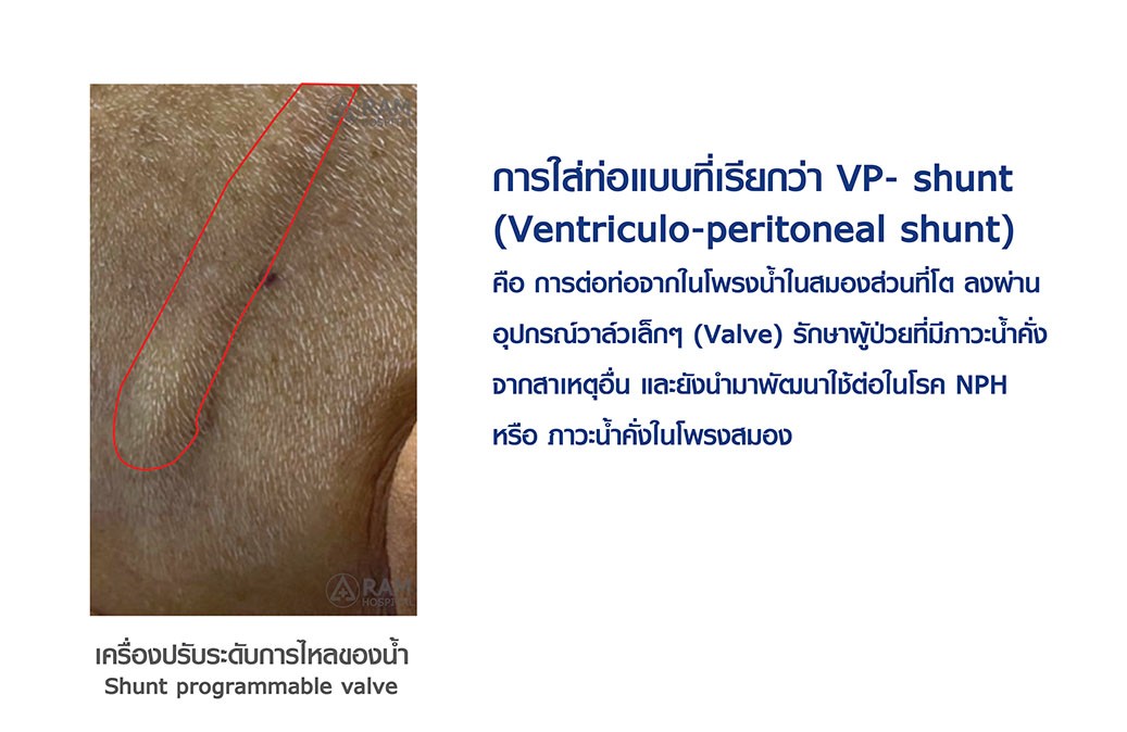 โรคน้ำคั่งในโพรงสมอง