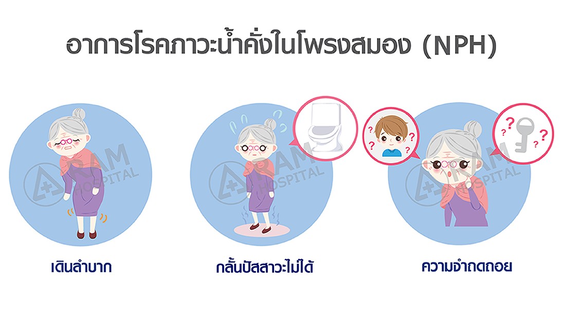 โรคน้ำคั่งในโพรงสมอง