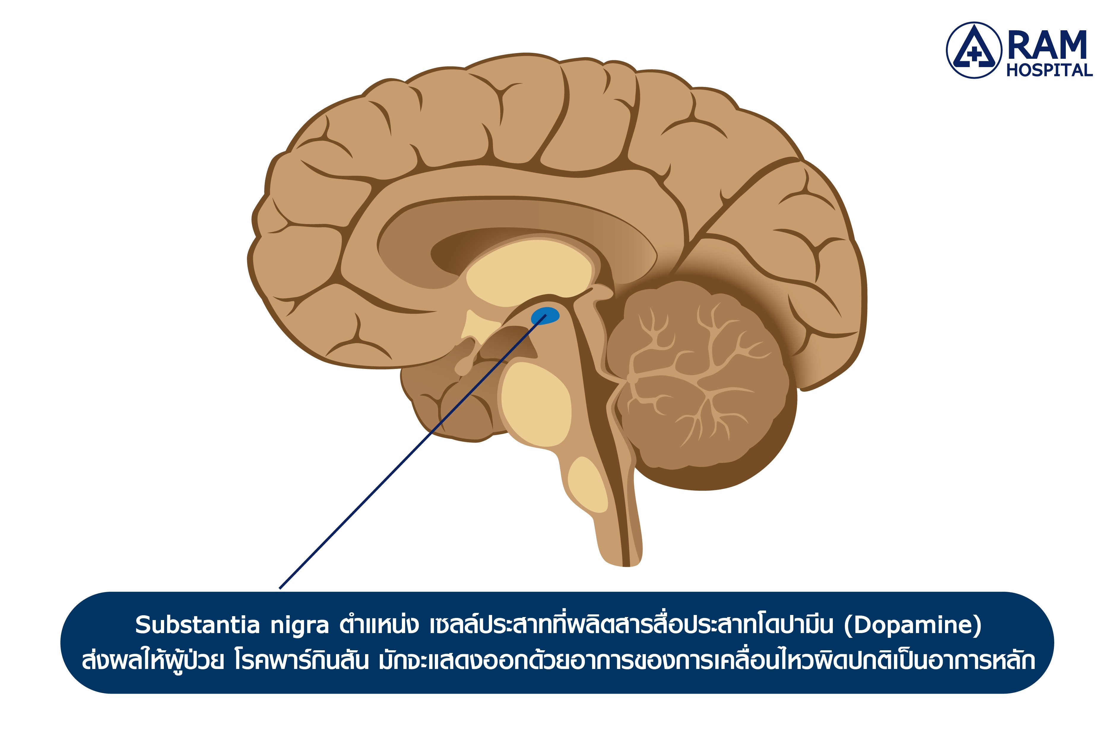 โรคพาร์กินสัน