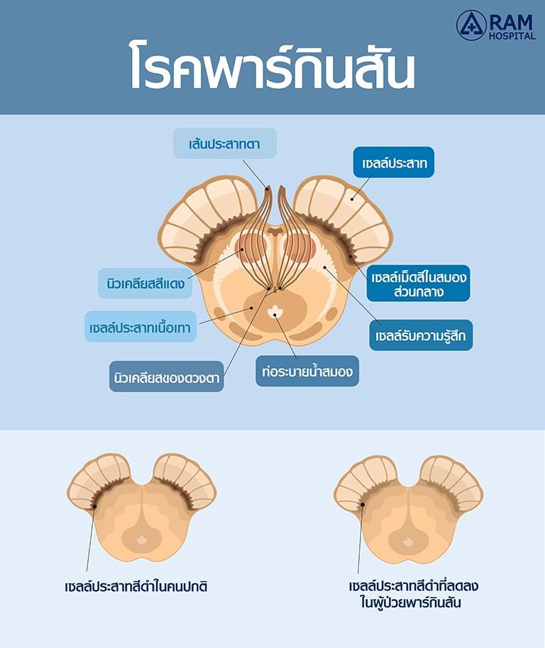 โรคพาร์กินสัน
