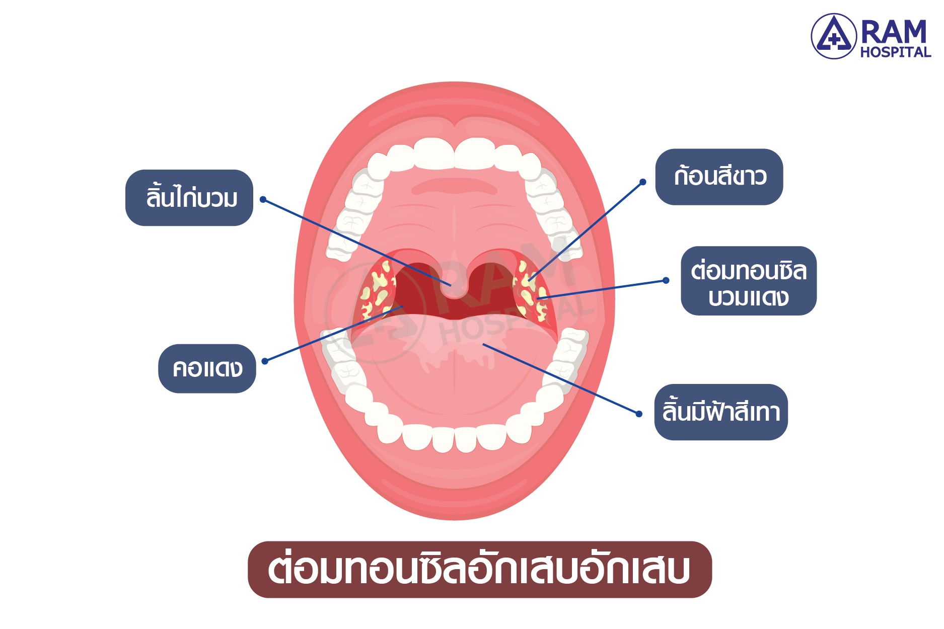 ทอนซิลอักเสบ