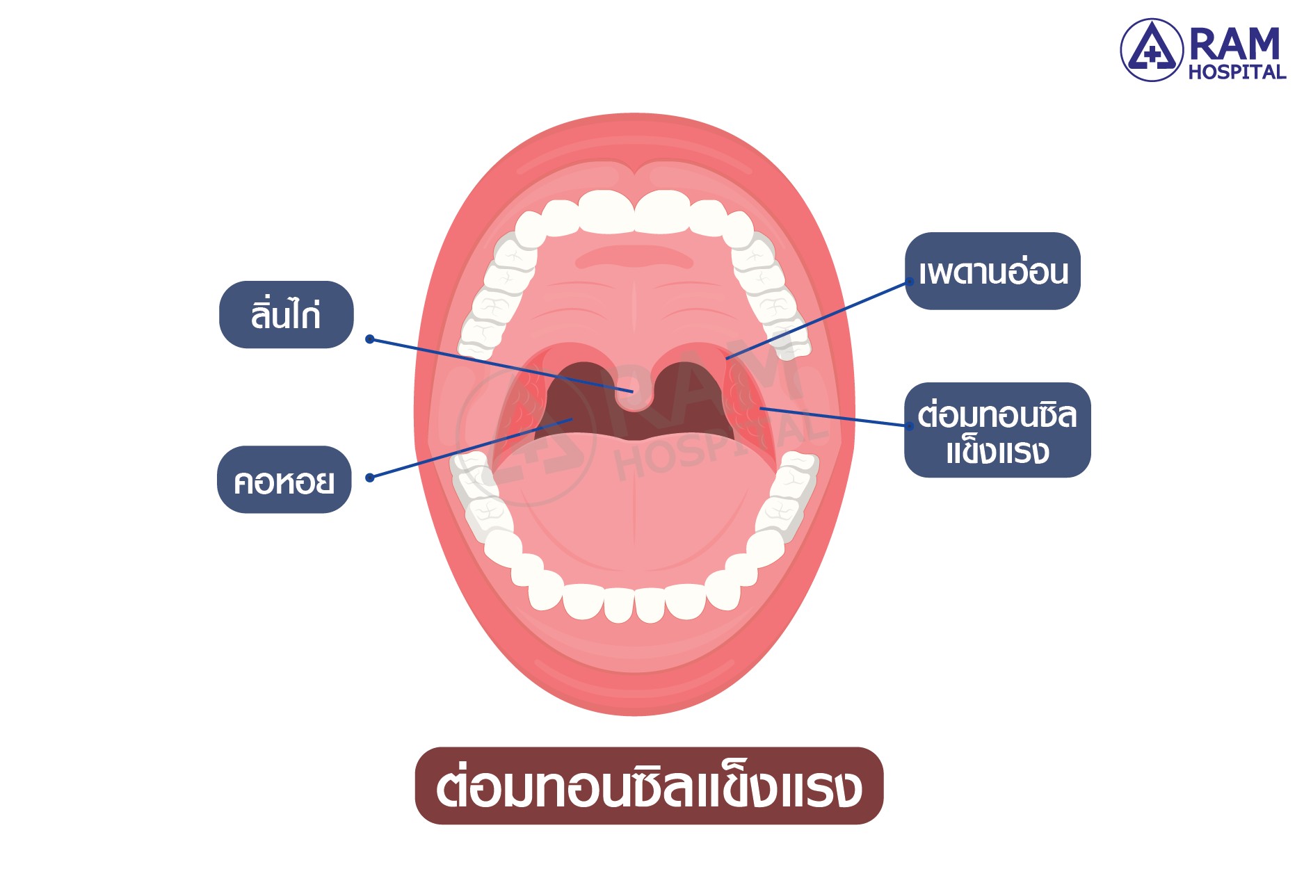 ทอนซิลอักเสบ