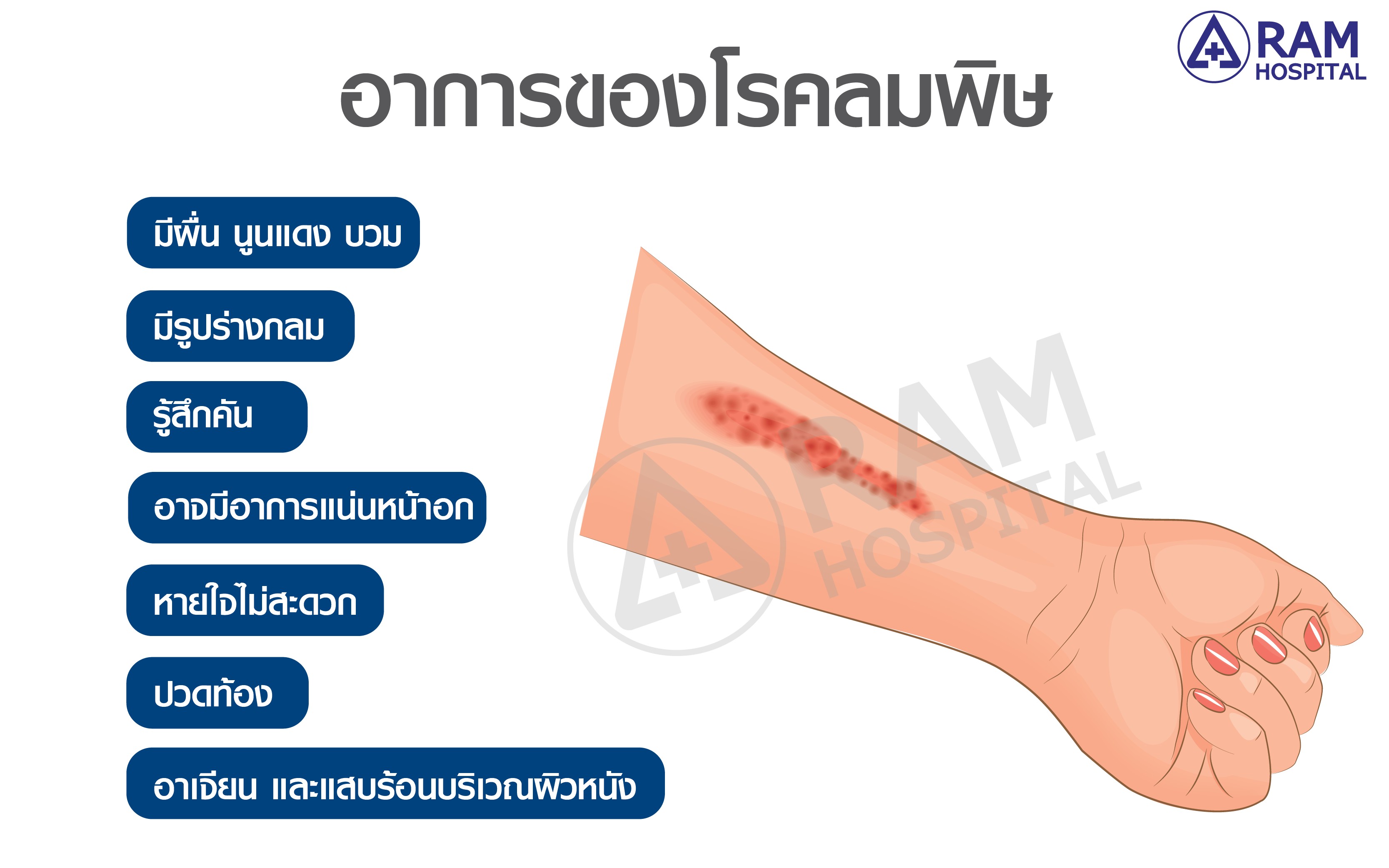 โรคลมพิษ