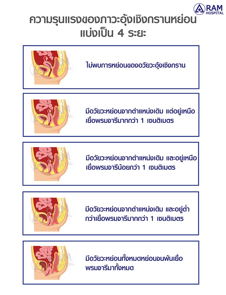 อุ้งเชิงกรานหย่อน