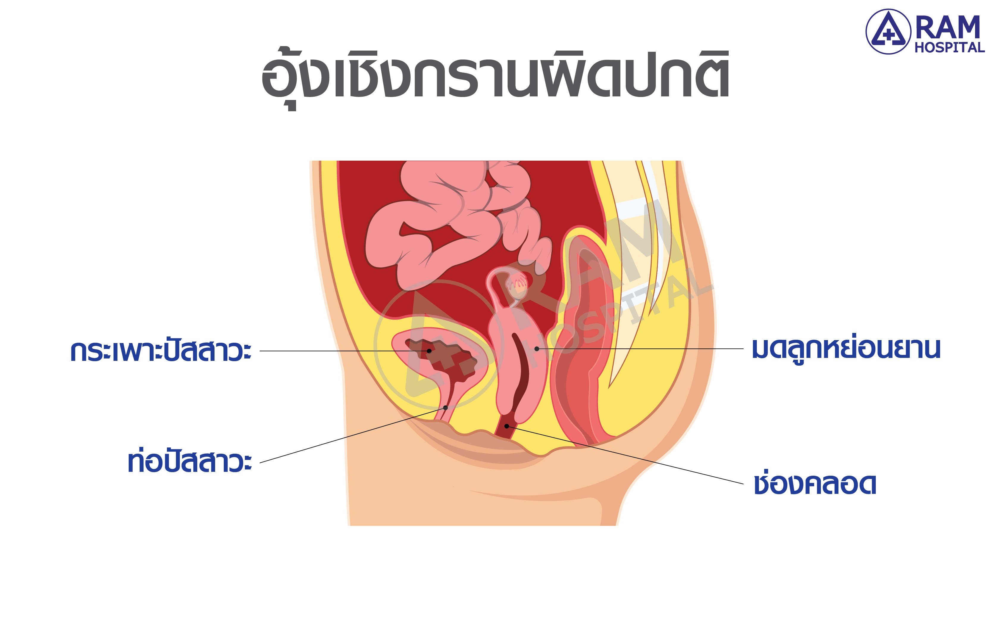 อุ้งเชิงกรานหย่อน