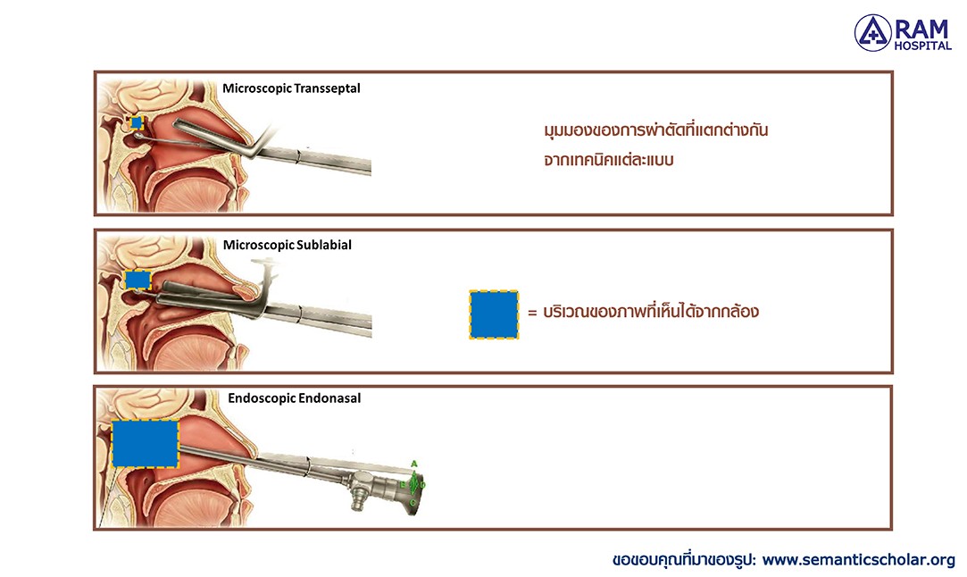 ศูนย์ผ่าตัดส่องกล้องเนื้องอกต่อมใต้สมอง