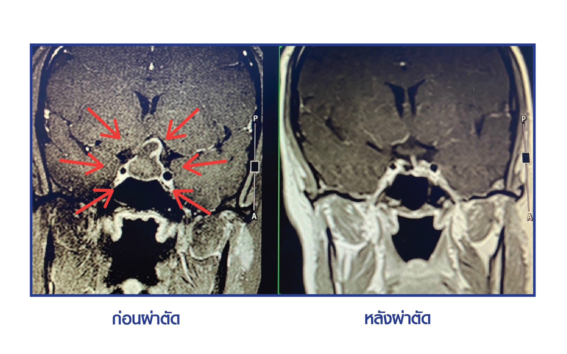 ศูนย์ผ่าตัดส่องกล้องเนื้องอกต่อมใต้สมอง