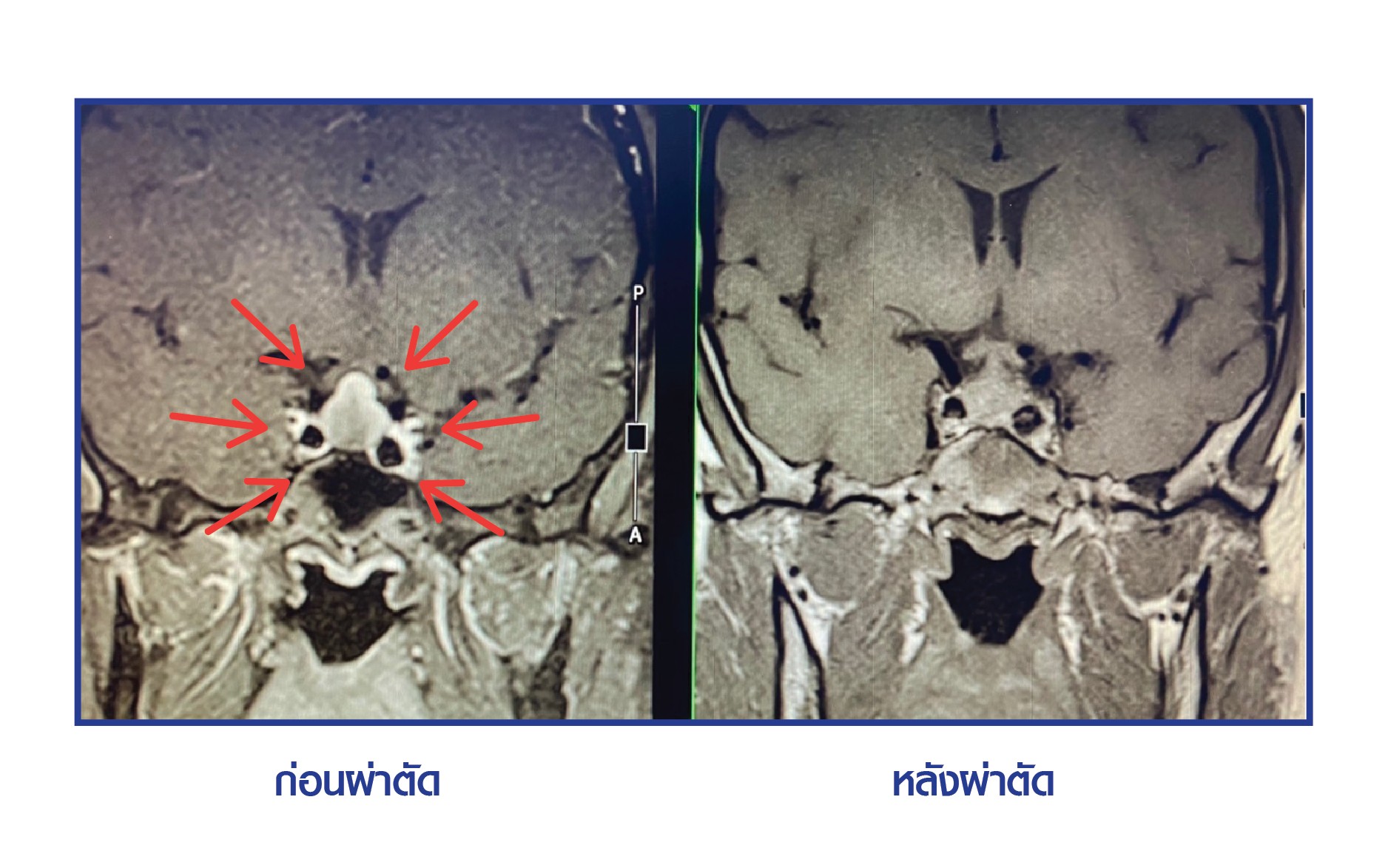 ศูนย์ผ่าตัดส่องกล้องเนื้องอกต่อมใต้สมอง