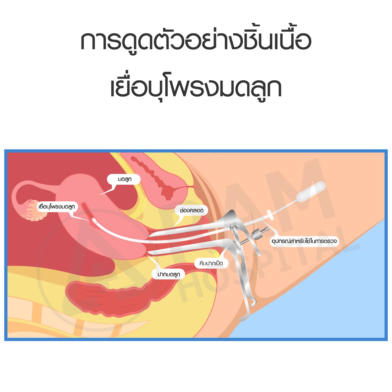 เลือดออกผิดปกติในสตรี