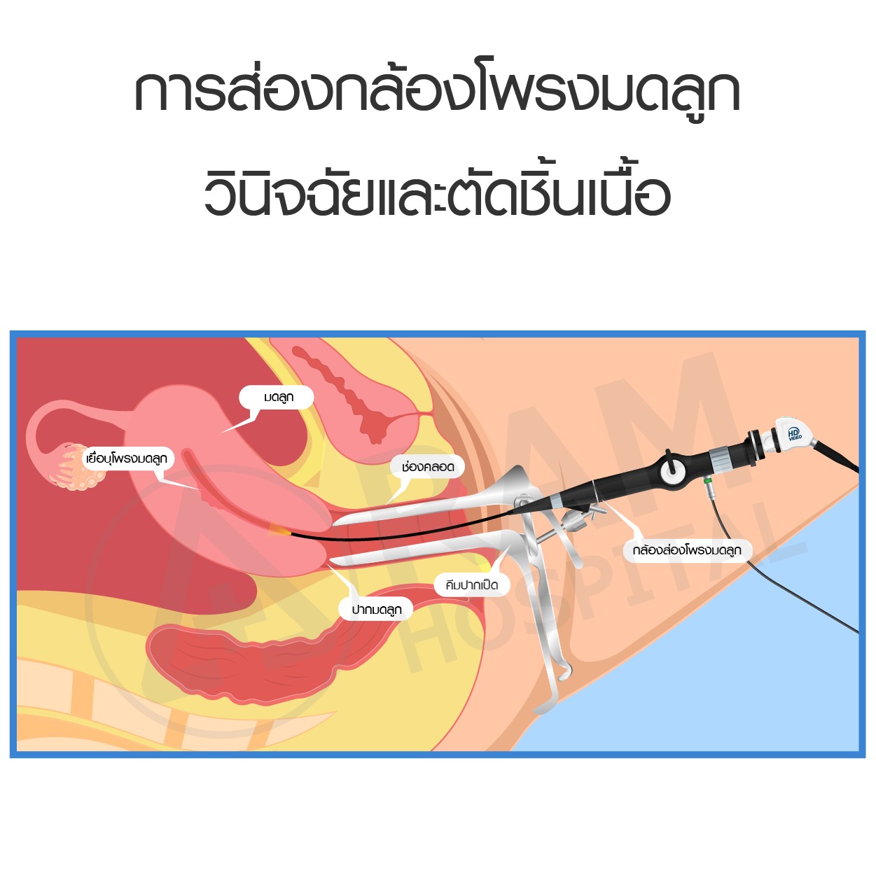 เลือดออกผิดปกติในสตรี