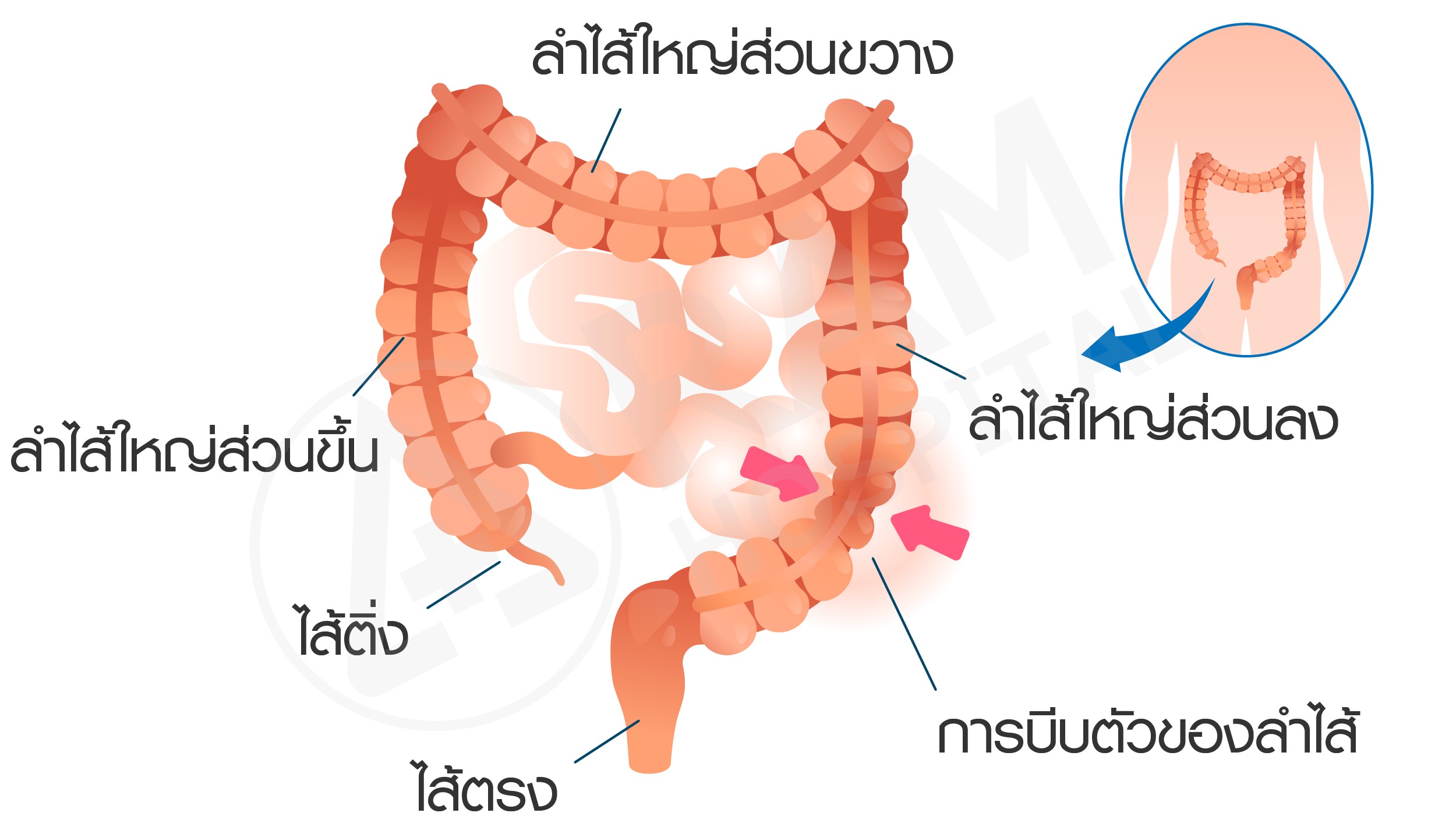 ท้องผูกสลับท้องเสีย