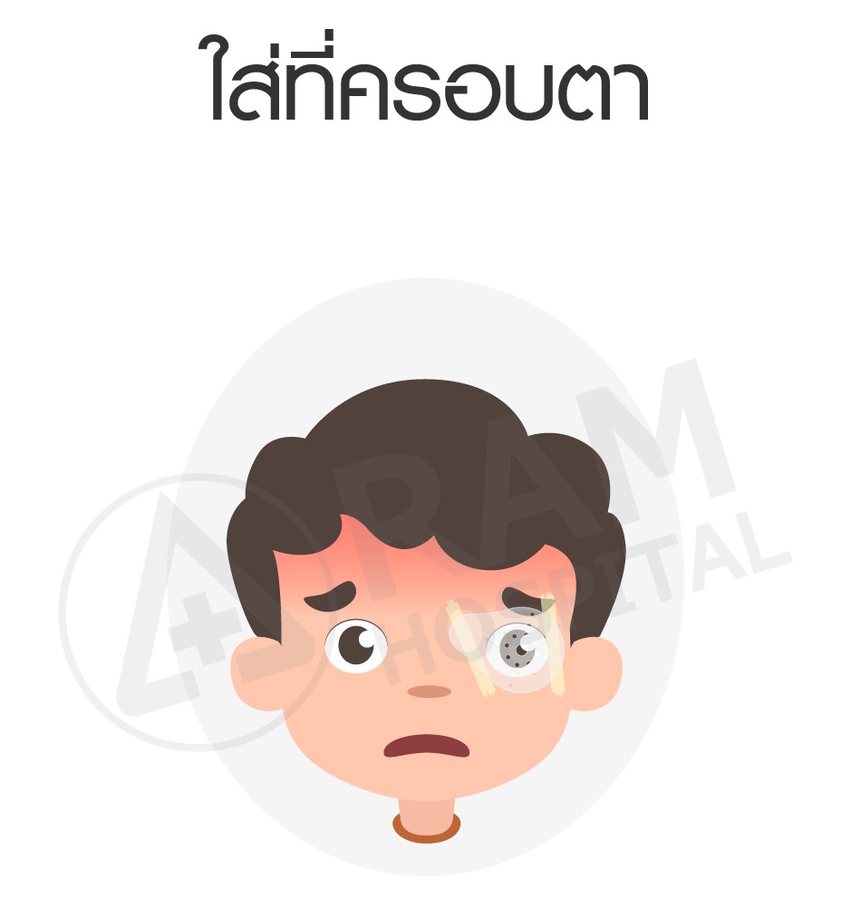 โรคตาขี้เกียจ