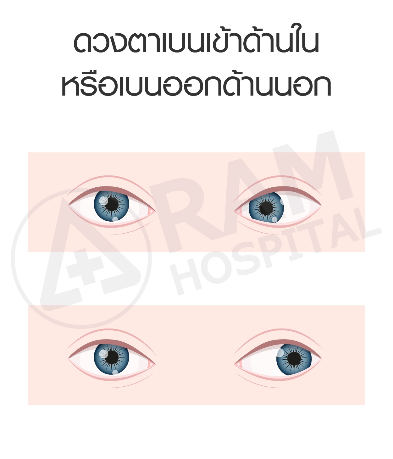 โรคตาขี้เกียจ