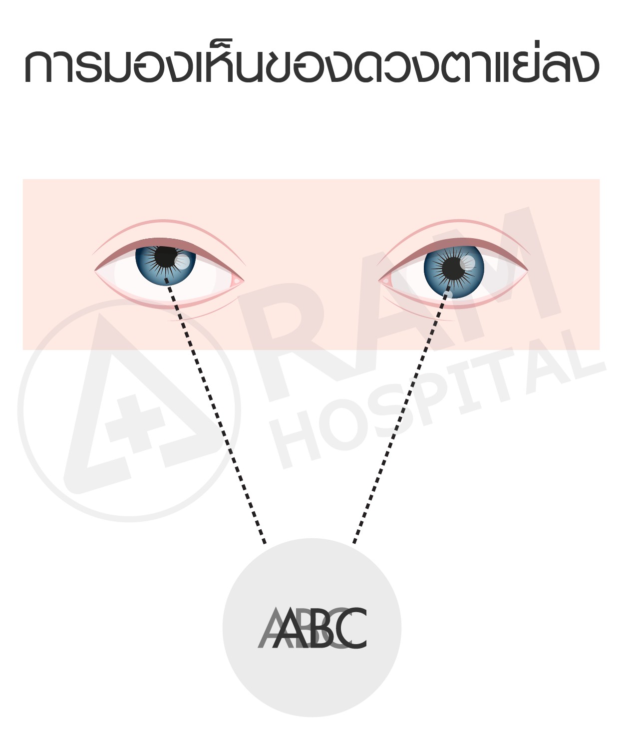 โรคตาขี้เกียจ