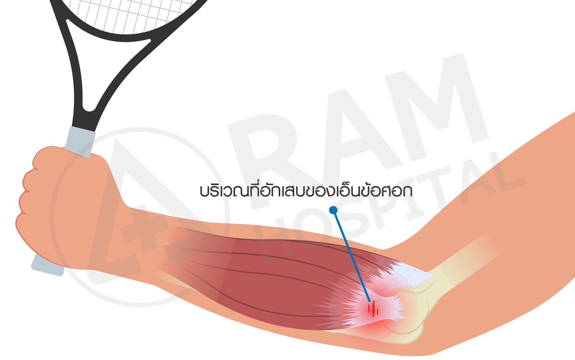 tennis elbow