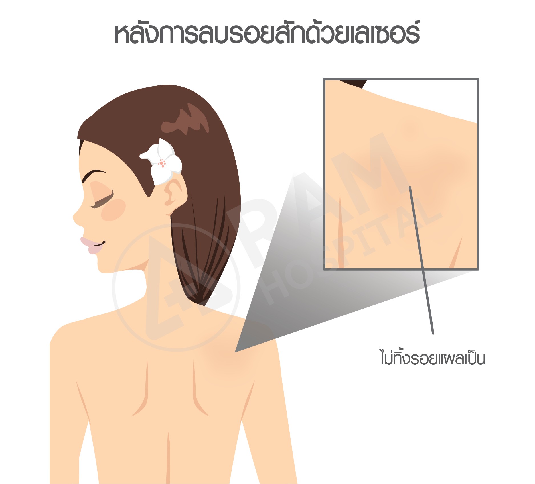 ลบรอยสัก