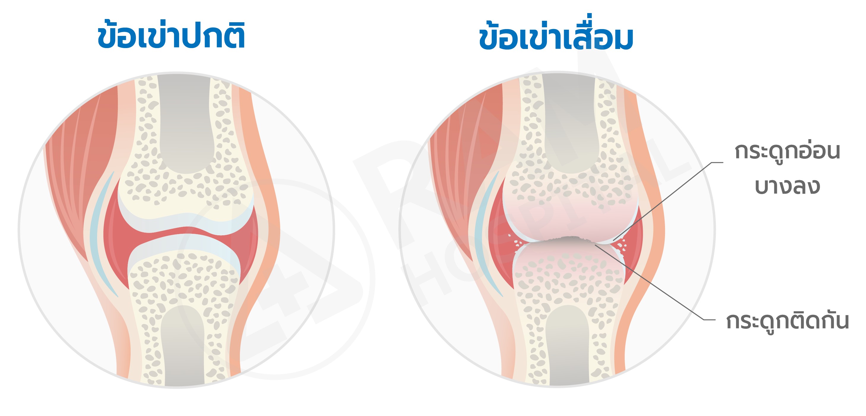 ข้อเข่าเสื่อม