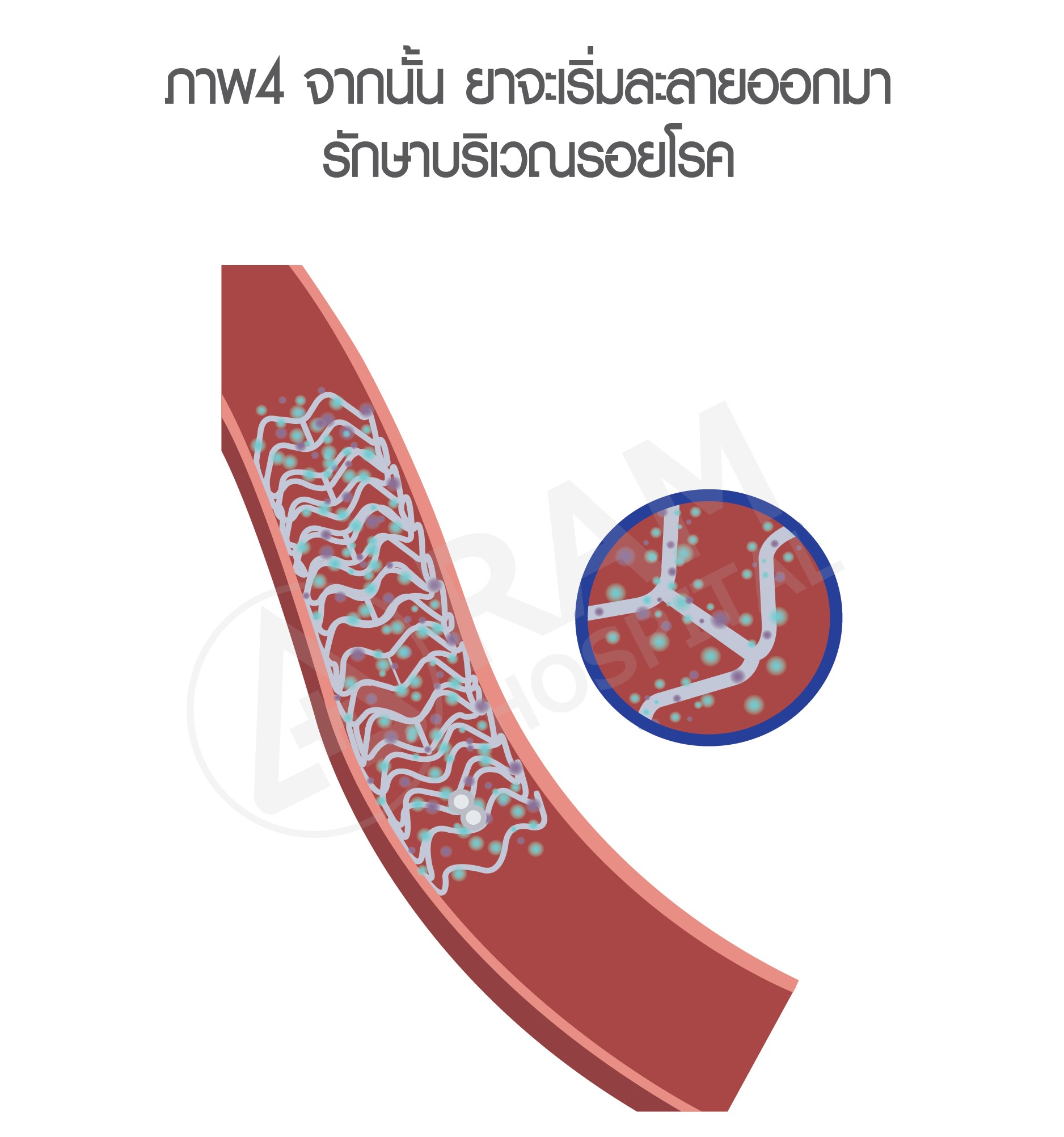 หัวใจตีบ รักษา บอลลูน
