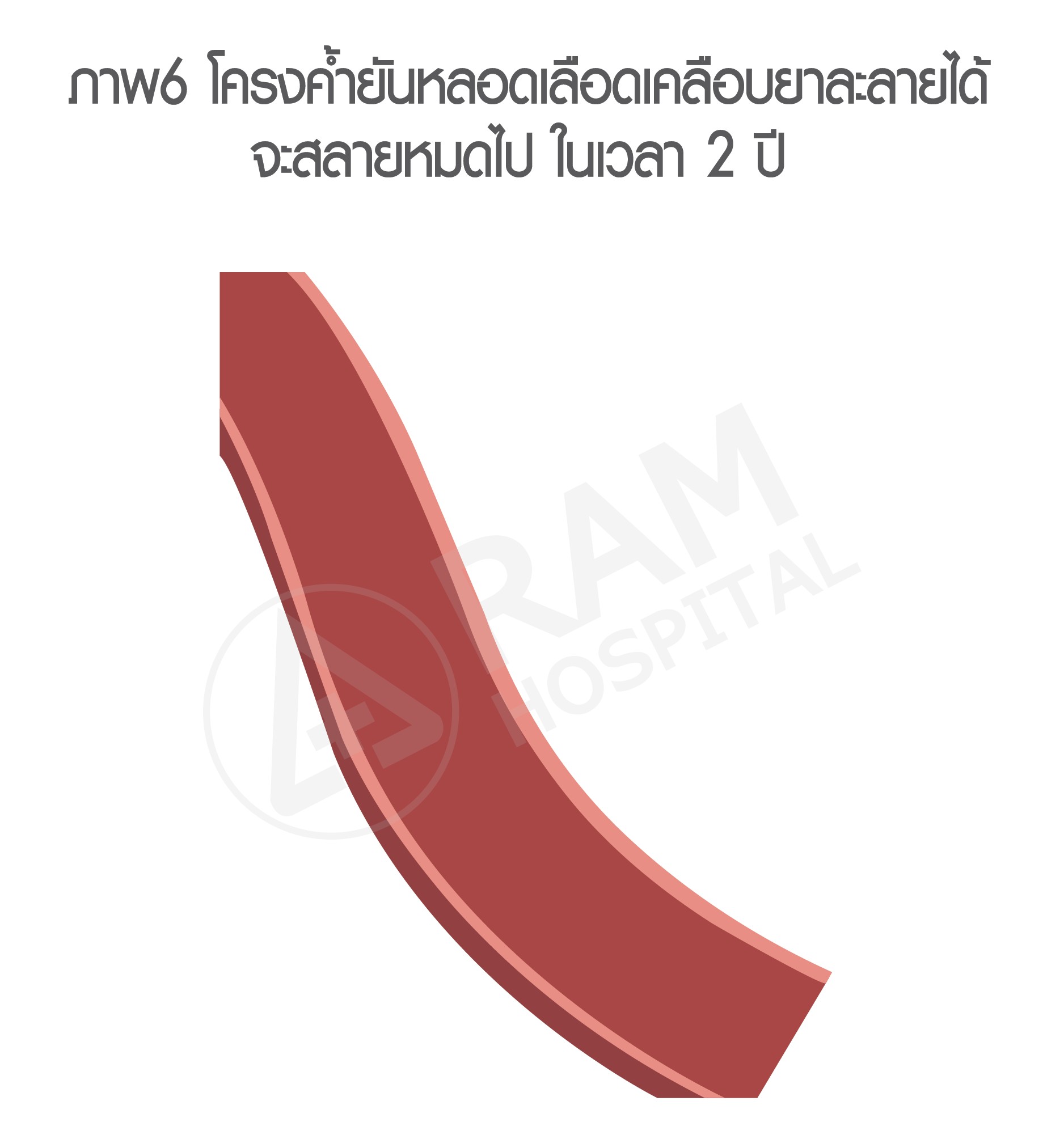 หัวใจตีบ รักษา บอลลูน