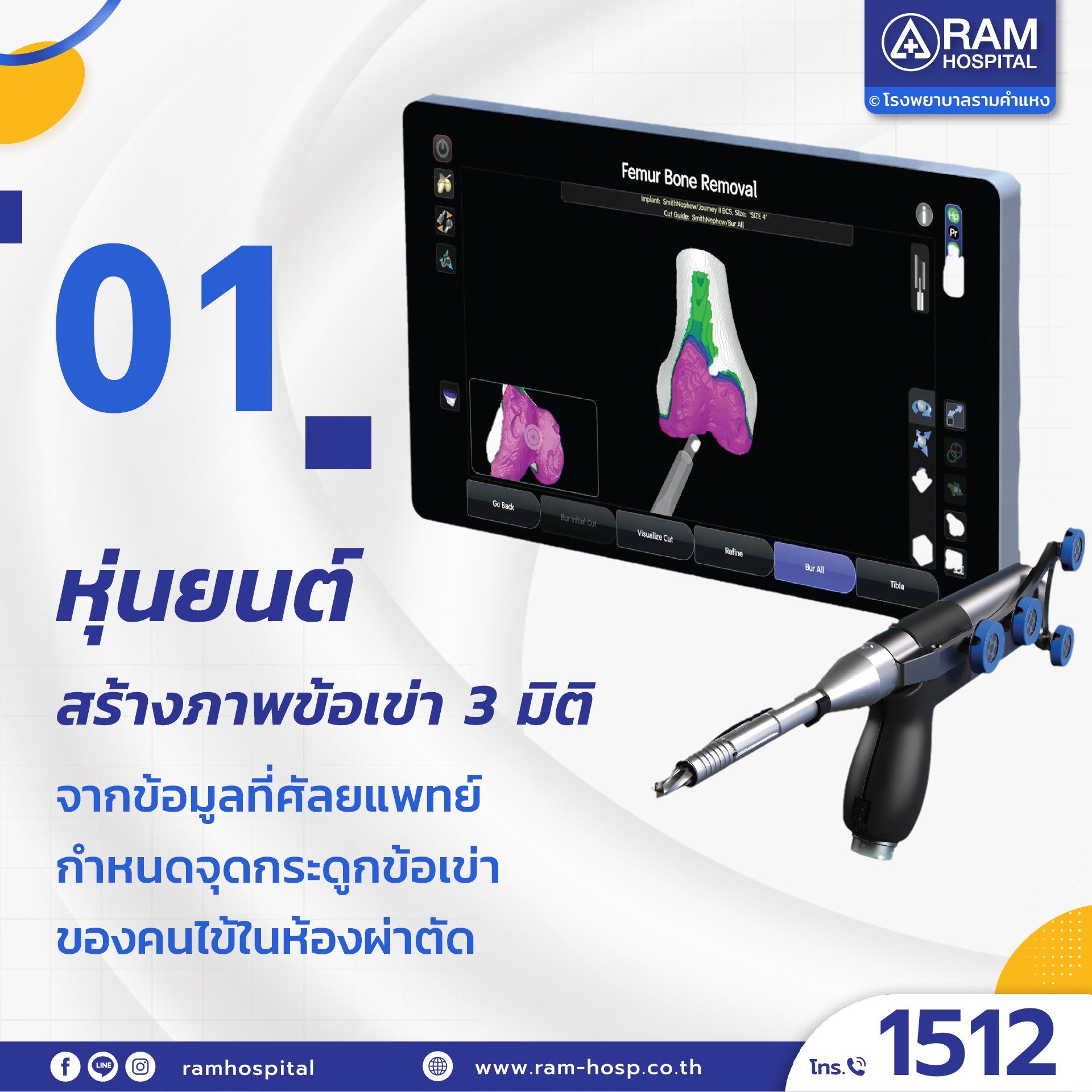 ผ่าตัดข้อเข่าเทียมด้วยหุ่นยนต์