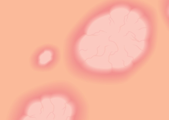 ตรวจเชื้อ hpv