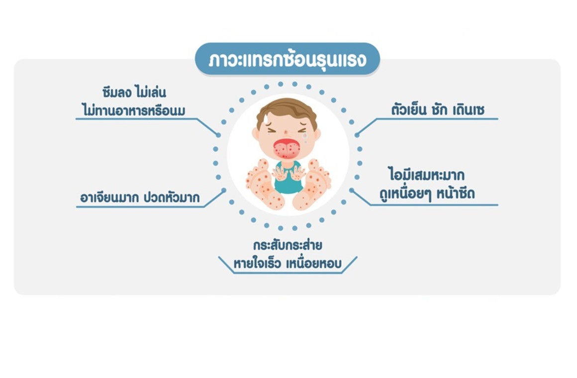 โรคมือเท้าปาก