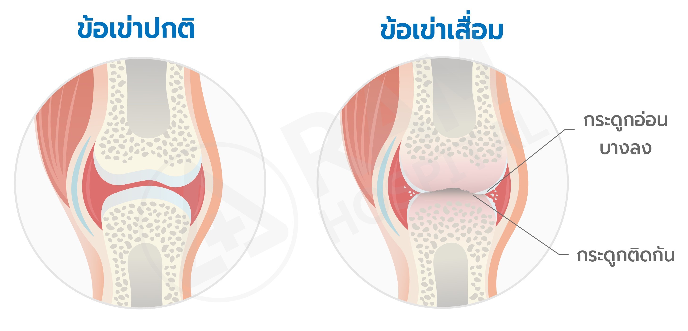 กายบริหาร ข้อเข่าเสื่อม