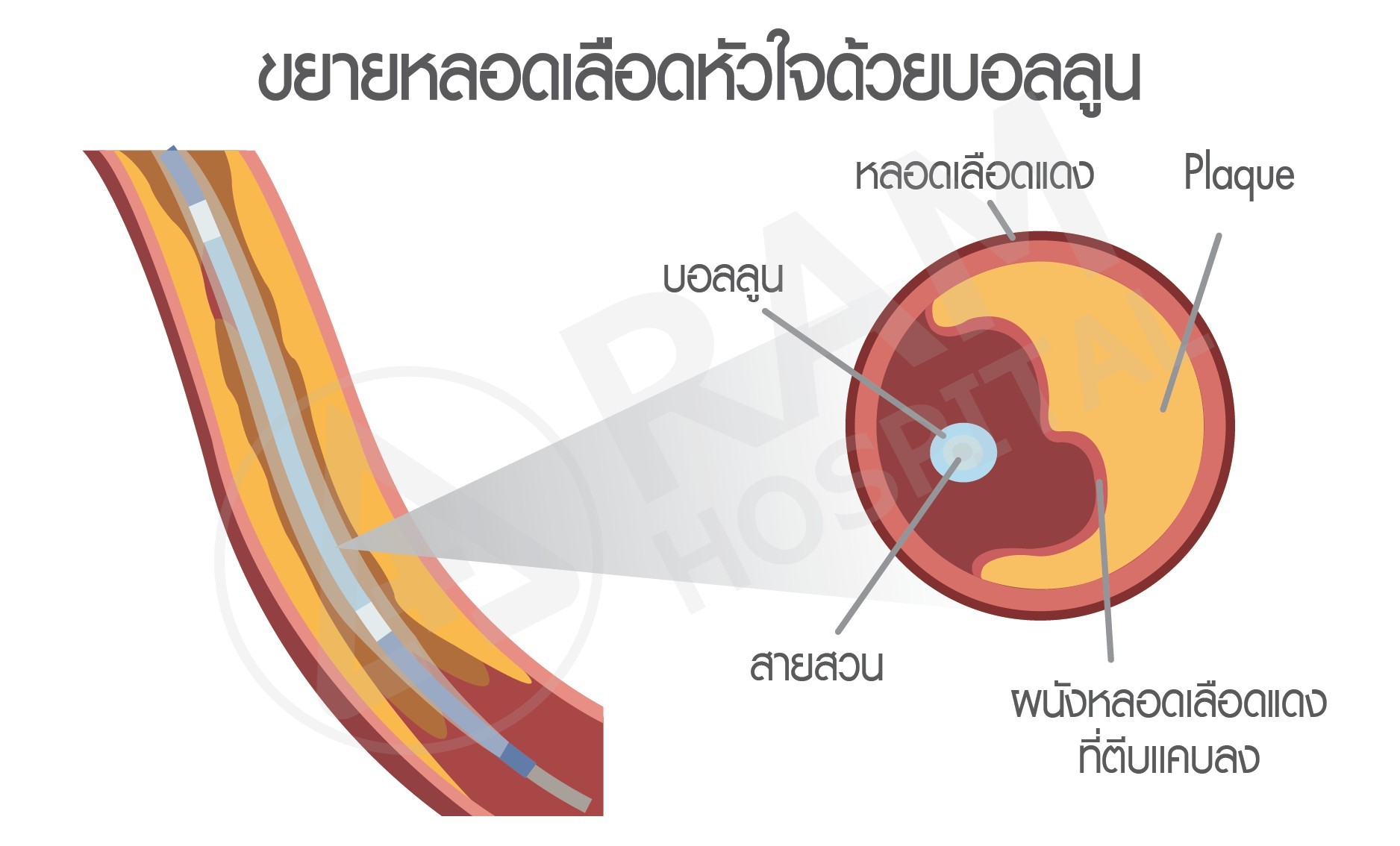 โรคหลอดเลือดหัวใจตีบ