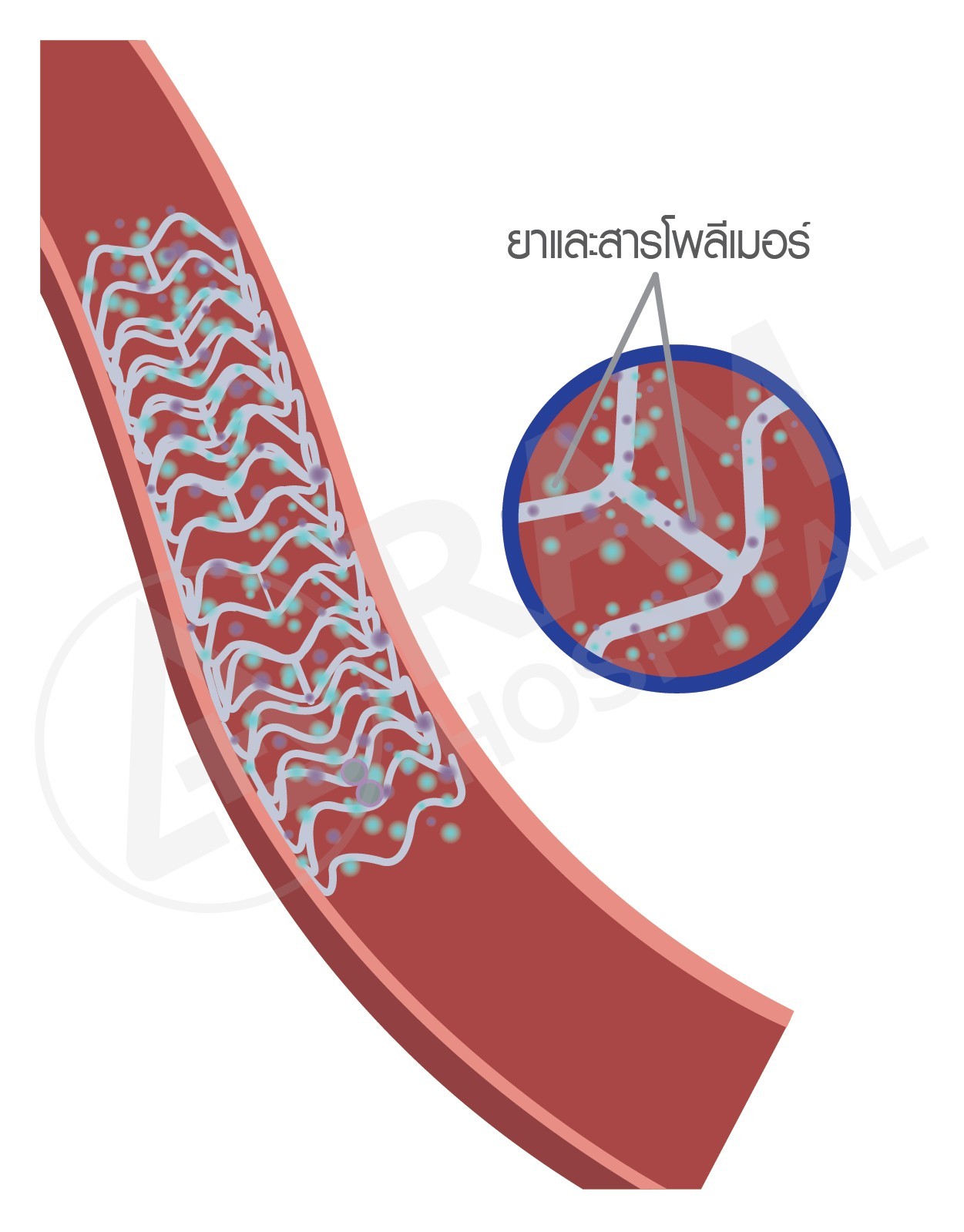 โรคหลอดเลือดหัวใจตีบ