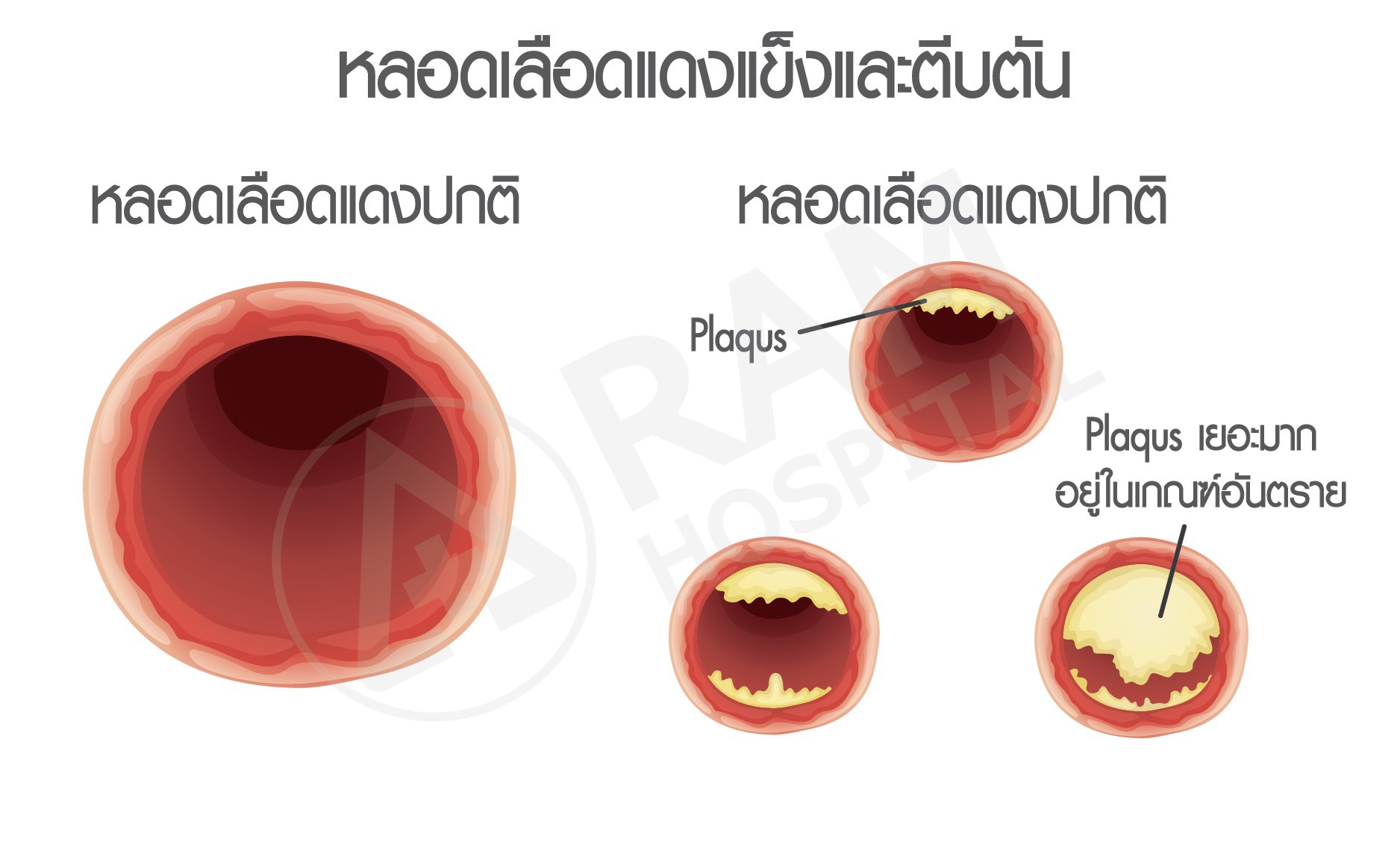 โรคความดันโลหิตสูง