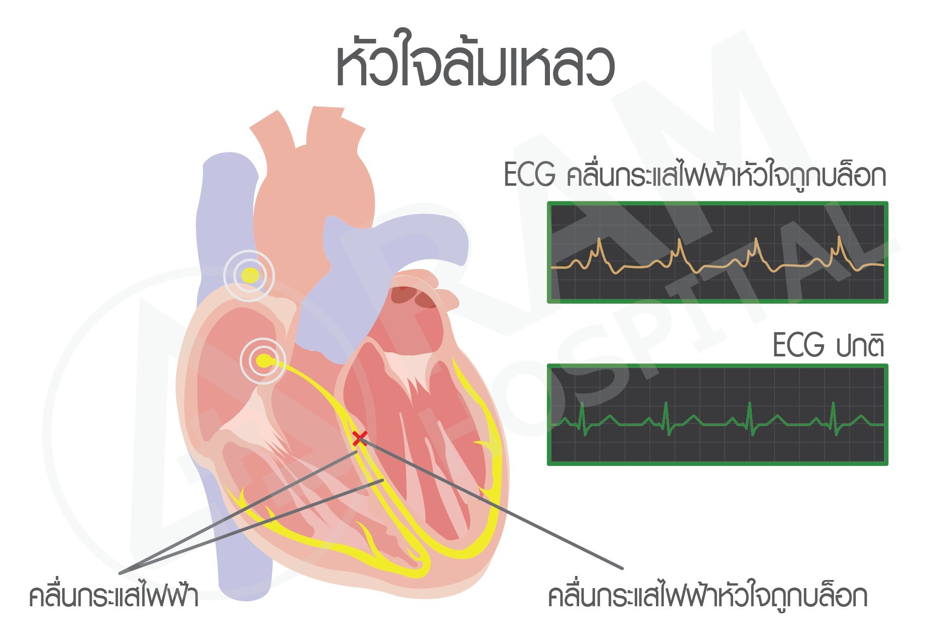 ออกกำลังกายในผู้ป่วยโรคหัวใจ