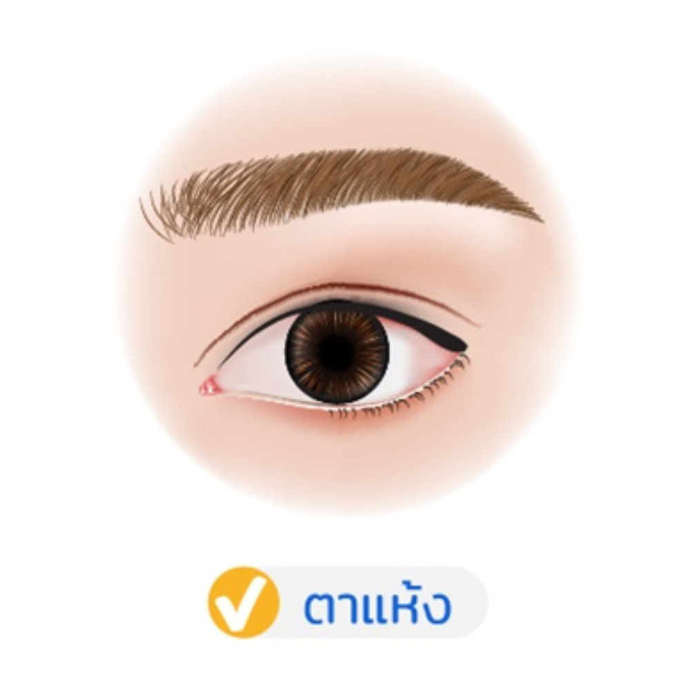 โรคตาแห้ง