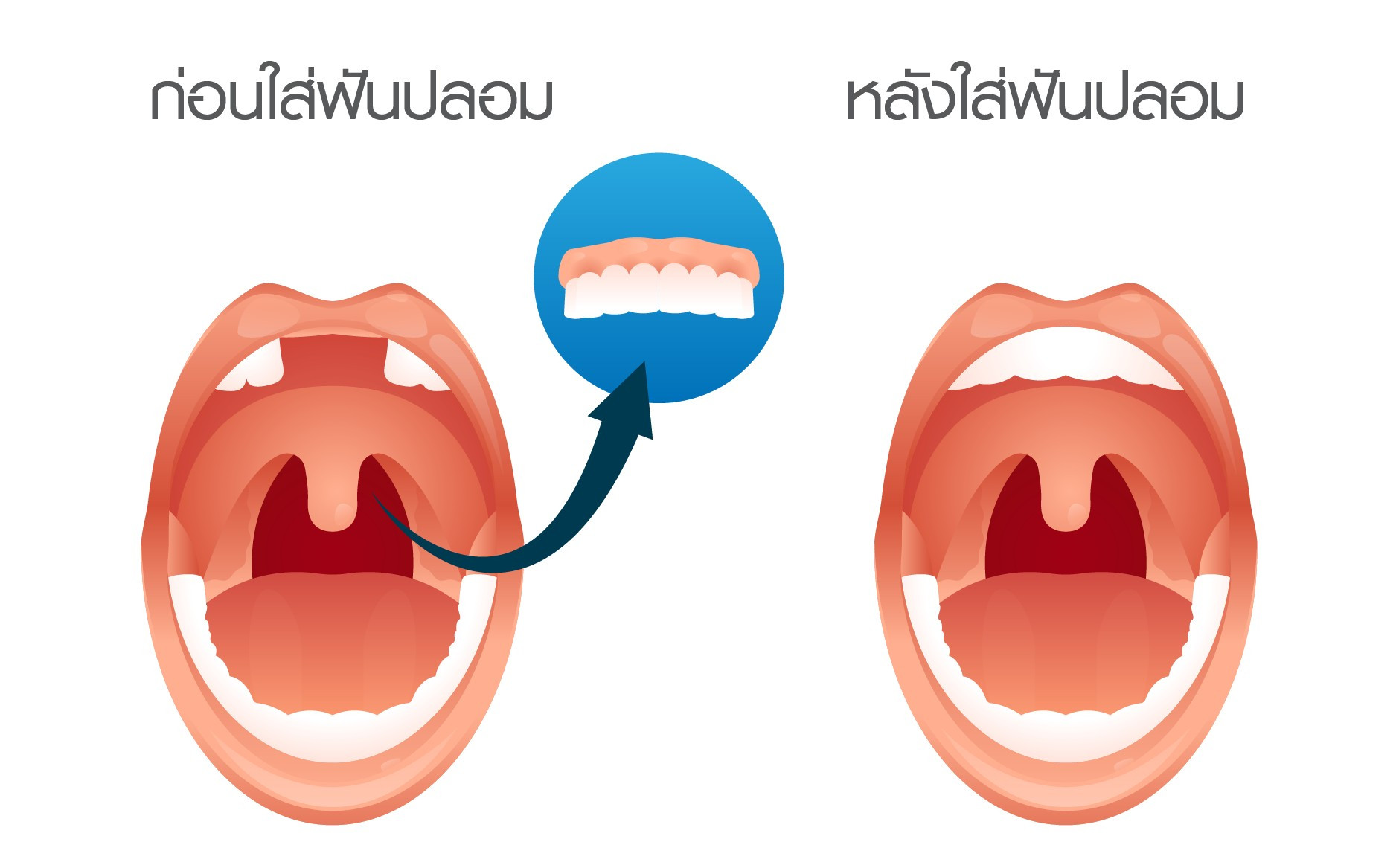 ฟันปลอม