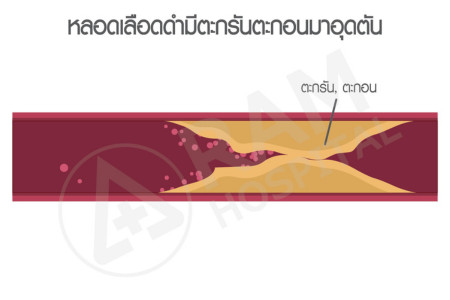 น้ำคั่งในโพรงสมอง