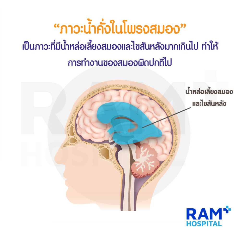 น้ำคั่งในโพรงสมอง