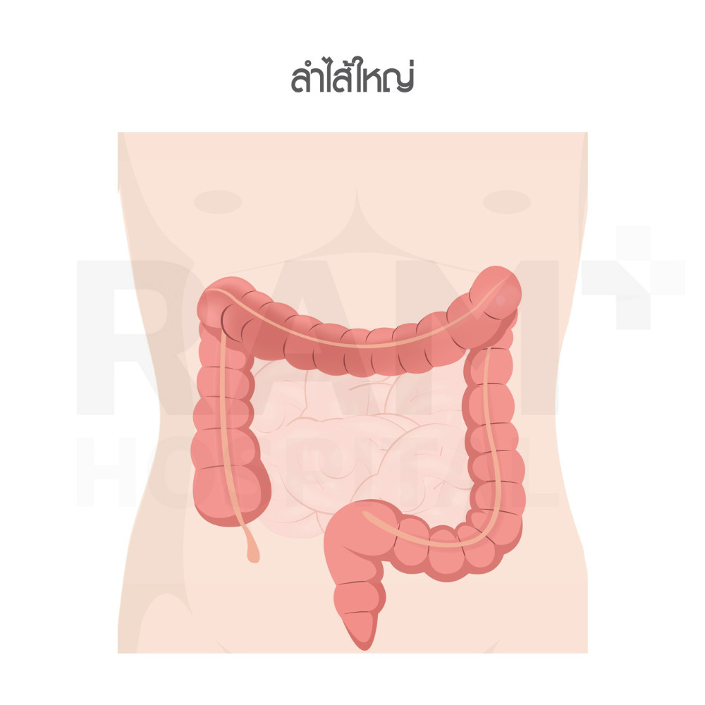 มะเร็งลำไส้ใหญ่