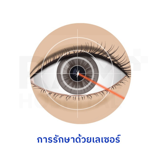 ต้อหิน