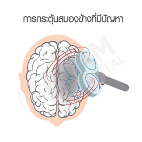 การรักษา tms