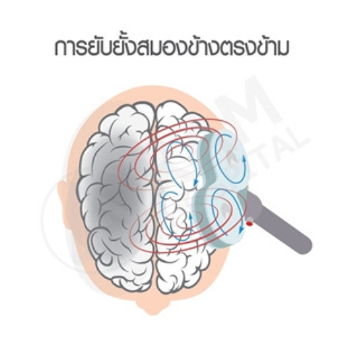 การรักษา tms