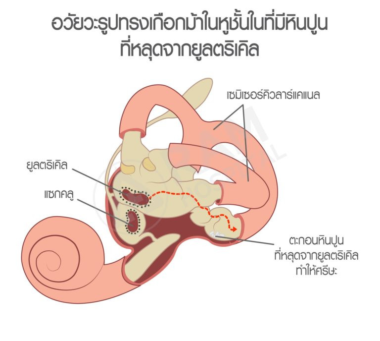 โรคหินปูนในหูชั้นใน