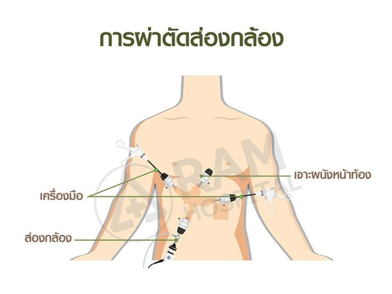 นิ่วในถุงน้ำดี