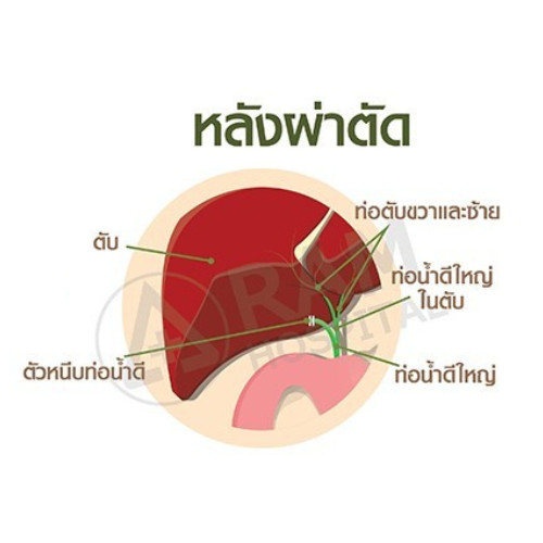 นิ่วในถุงน้ำดี