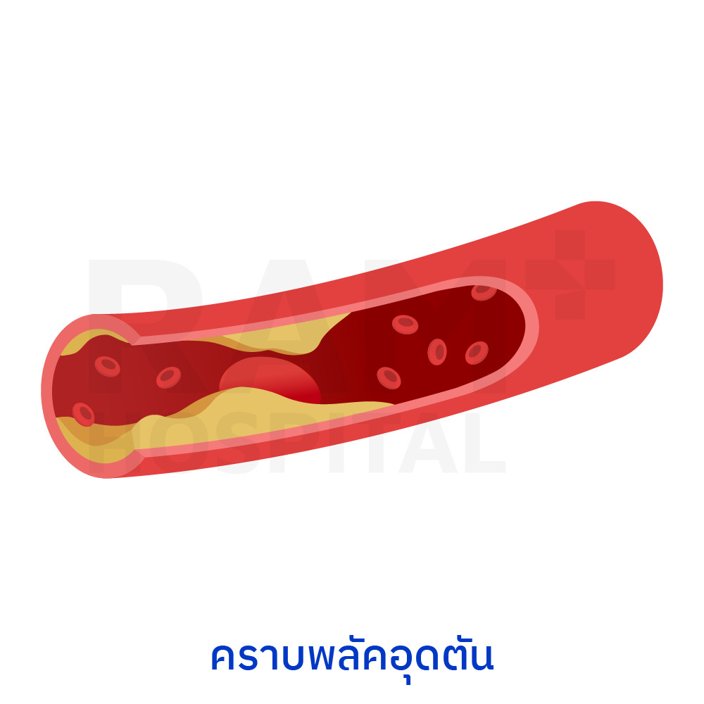 tmao สมองเสื่อม